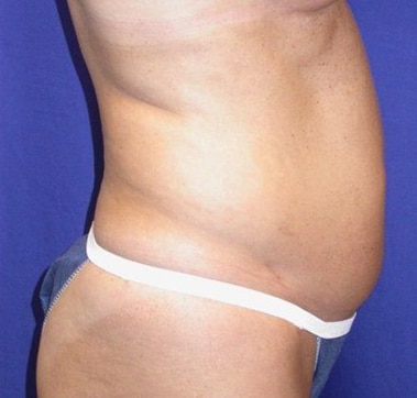 Before Image: Case #754 – Abdominoplasty – Tummy Tuck - right-side