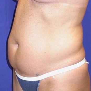 Before Image: Case #754 – Abdominoplasty – Tummy Tuck - left-front-oblique