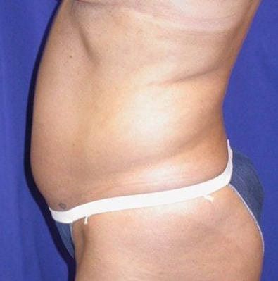 Before Image: Case #754 – Abdominoplasty – Tummy Tuck - left-side