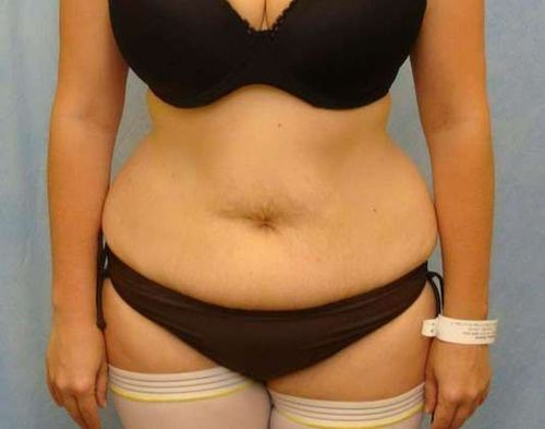 Before Image: Case #766 – Abdominoplasty – Tummy Tuck - front