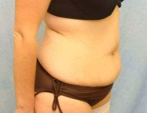 Before Image: Case #766 – Abdominoplasty – Tummy Tuck - right-front-oblique