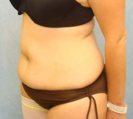 Before Image: Case #766 – Abdominoplasty – Tummy Tuck - left-front-oblique