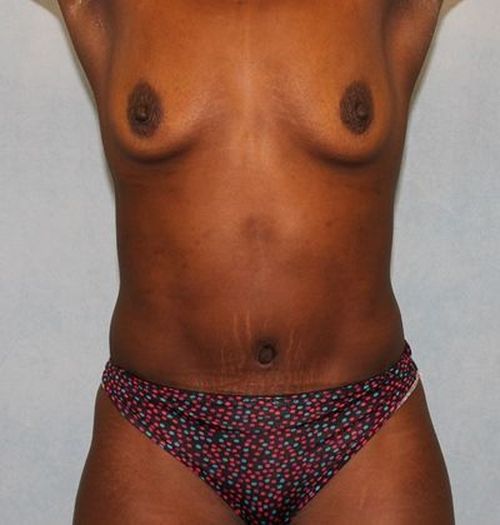 After Image: Case #788 – Abdominoplasty – Tummy Tuck - front
