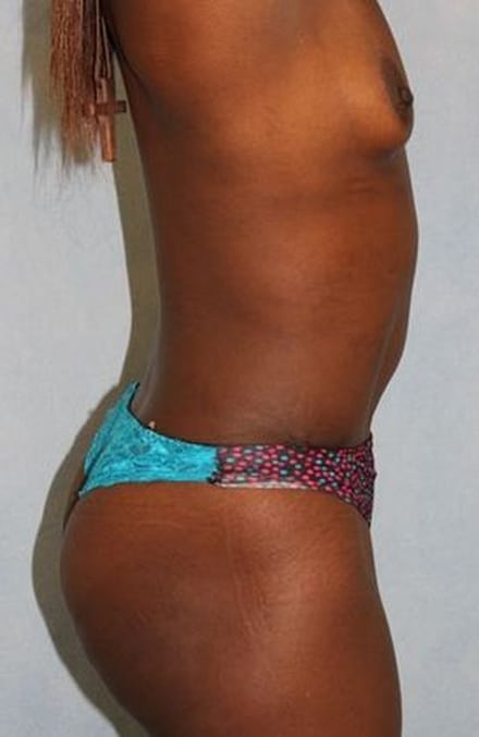 After Image: Case #788 – Abdominoplasty – Tummy Tuck - right-side