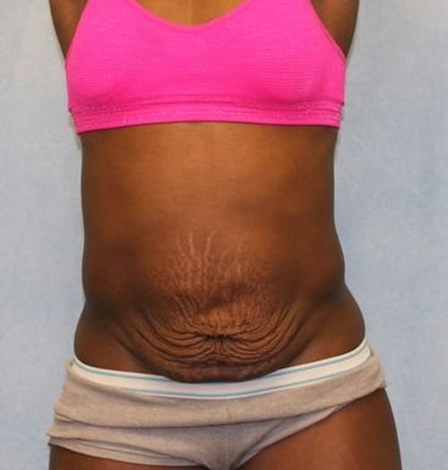 Before Image: Case #788 – Abdominoplasty – Tummy Tuck - front