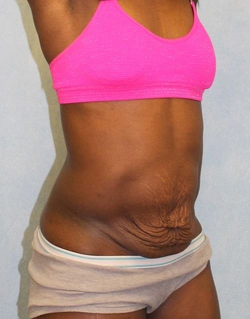 Before Image: Case #788 – Abdominoplasty – Tummy Tuck - right-front-oblique