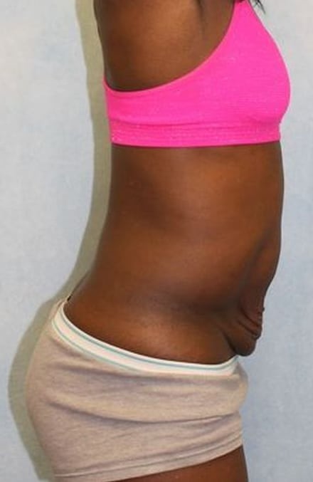 Before Image: Case #788 – Abdominoplasty – Tummy Tuck - right-side