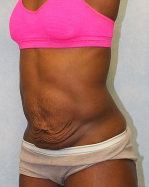Before Image: Case #788 – Abdominoplasty – Tummy Tuck - left-front-oblique