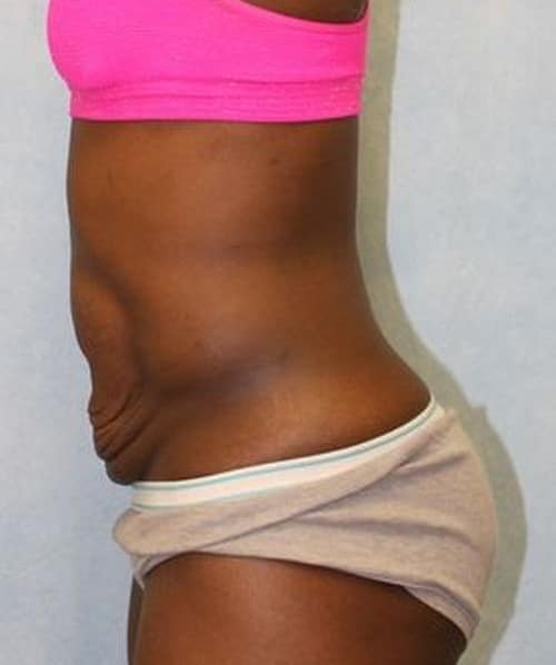 Before Image: Case #788 – Abdominoplasty – Tummy Tuck - left-side