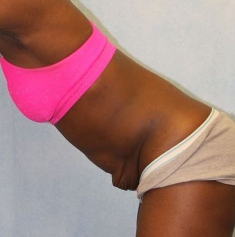 Before Image: Case #788 – Abdominoplasty – Tummy Tuck - left-front-oblique