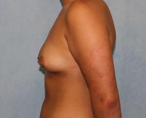 Before Image: Case #81 – Breast Augmentation - left-side