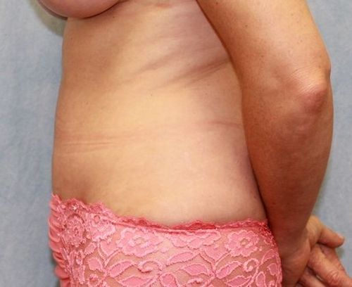After Image: Case #816 – Abdominoplasty – Tummy Tuck - left-side