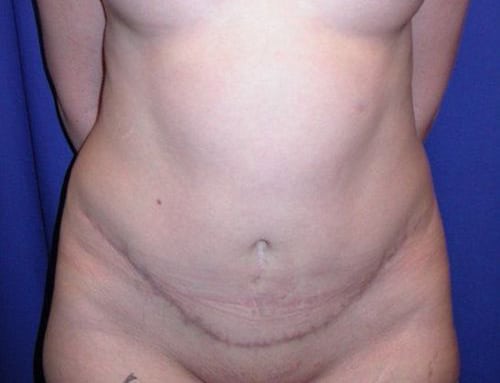 After Image: Case #826 – Abdominoplasty – Tummy Tuck - front
