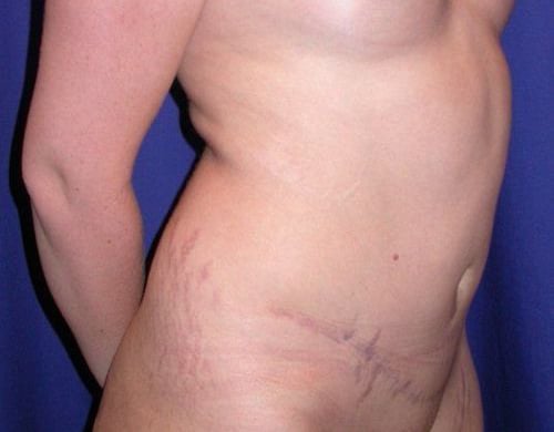 After Image: Case #826 – Abdominoplasty – Tummy Tuck - right-front-oblique