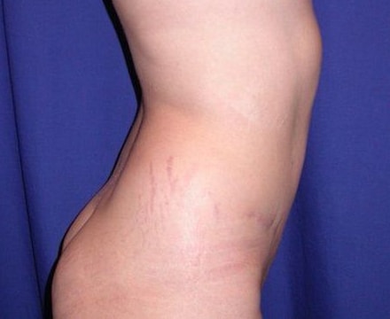 After Image: Case #826 – Abdominoplasty – Tummy Tuck - right-side