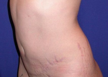After Image: Case #826 – Abdominoplasty – Tummy Tuck - left-front-oblique
