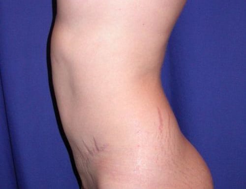 After Image: Case #826 – Abdominoplasty – Tummy Tuck - left-side