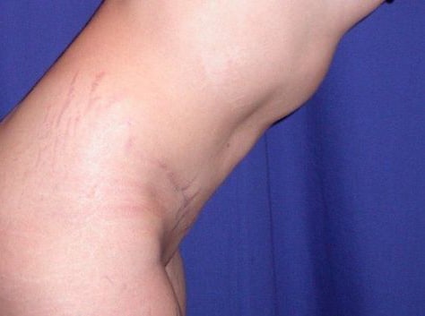After Image: Case #826 – Abdominoplasty – Tummy Tuck - right-front-oblique