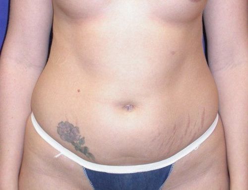 Before Image: Case #826 – Abdominoplasty – Tummy Tuck - front