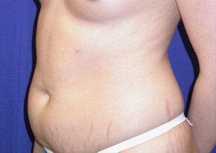 Before Image: Case #826 – Abdominoplasty – Tummy Tuck - left-front-oblique