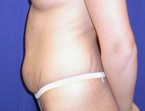 Before Image: Case #826 – Abdominoplasty – Tummy Tuck - left-side