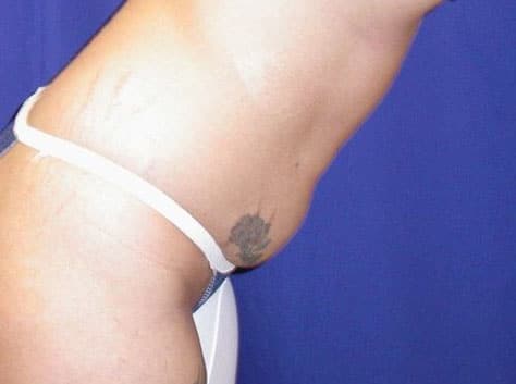 Before Image: Case #826 – Abdominoplasty – Tummy Tuck - right-front-oblique