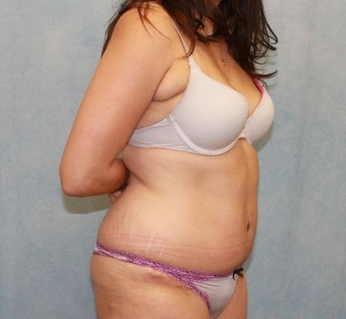After Image: Case #840 – Abdominoplasty – Tummy Tuck - right-front-oblique