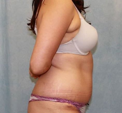 After Image: Case #840 – Abdominoplasty – Tummy Tuck - right-side
