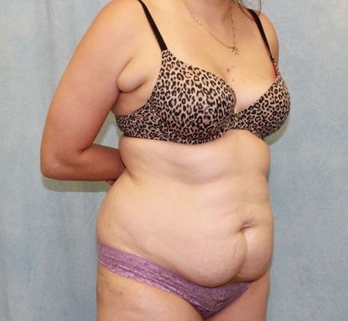Before Image: Case #840 – Abdominoplasty – Tummy Tuck - right-front-oblique