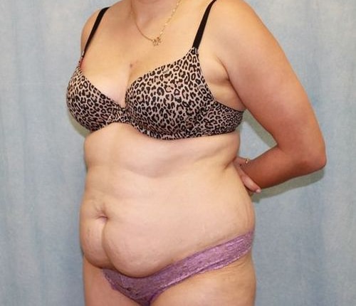 Before Image: Case #840 – Abdominoplasty – Tummy Tuck - left-front-oblique
