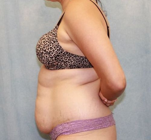 Before Image: Case #840 – Abdominoplasty – Tummy Tuck - left-side