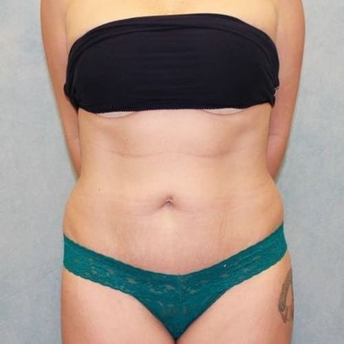 After Image: Case #868 – Abdominoplasty – Tummy Tuck - front