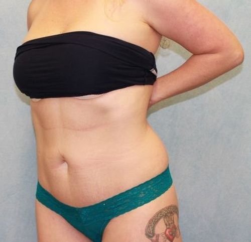 After Image: Case #868 – Abdominoplasty – Tummy Tuck - left-front-oblique