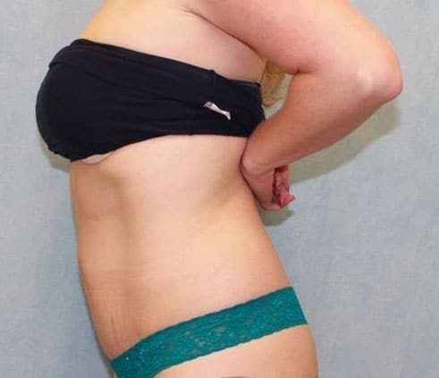 After Image: Case #868 – Abdominoplasty – Tummy Tuck - left-side