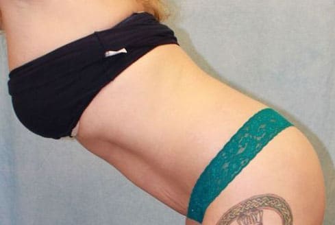 After Image: Case #868 – Abdominoplasty – Tummy Tuck - left-front-oblique