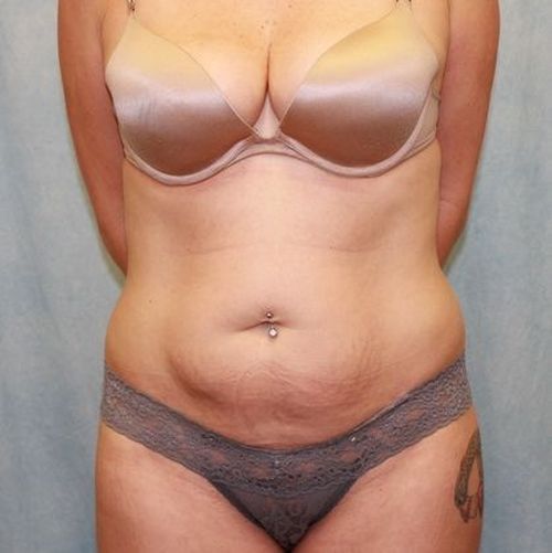 Before Image: Case #868 – Abdominoplasty – Tummy Tuck - front