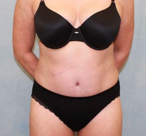 After Image: Case #882 – Abdominoplasty – Tummy Tuck - front