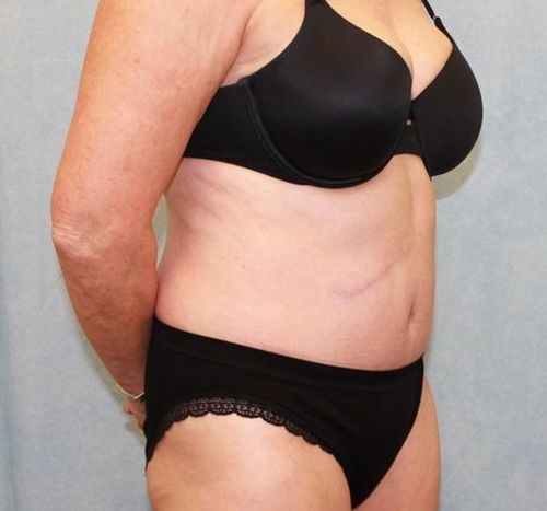 After Image: Case #882 – Abdominoplasty – Tummy Tuck - right-front-oblique
