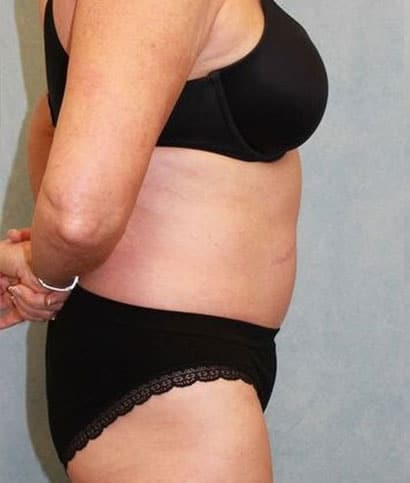 After Image: Case #882 – Abdominoplasty – Tummy Tuck - right-side