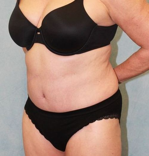After Image: Case #882 – Abdominoplasty – Tummy Tuck - left-front-oblique