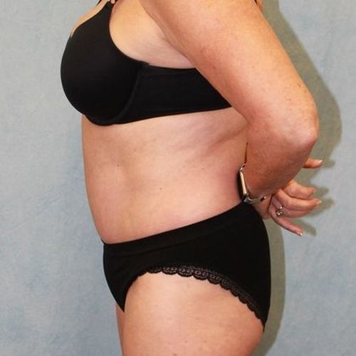 After Image: Case #882 – Abdominoplasty – Tummy Tuck - left-side