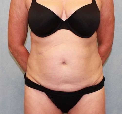 Before Image: Case #882 – Abdominoplasty – Tummy Tuck - front