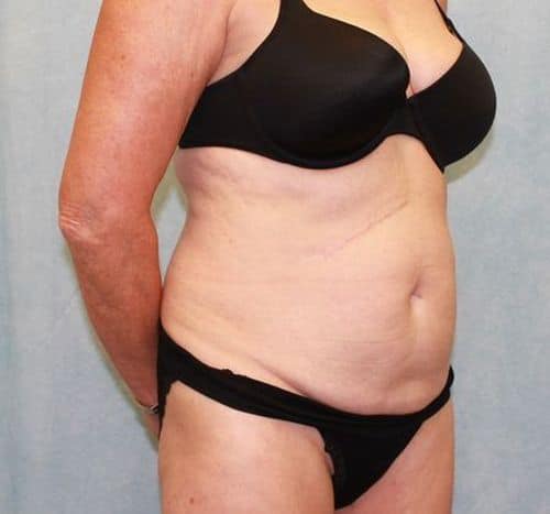 Before Image: Case #882 – Abdominoplasty – Tummy Tuck - right-front-oblique