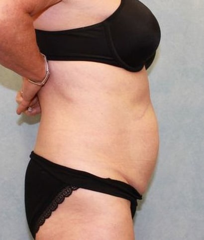 Before Image: Case #882 – Abdominoplasty – Tummy Tuck - right-side