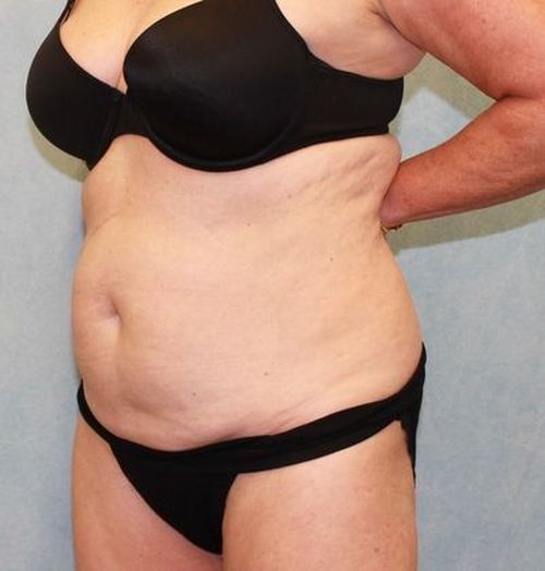 Before Image: Case #882 – Abdominoplasty – Tummy Tuck - left-front-oblique