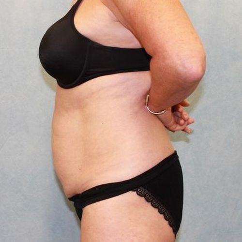 Before Image: Case #882 – Abdominoplasty – Tummy Tuck - left-side