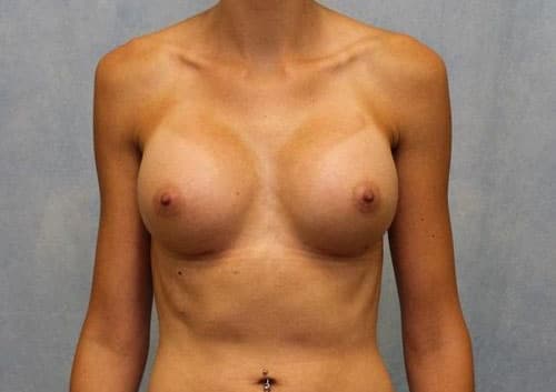 Case #93 – Breast Augmentation