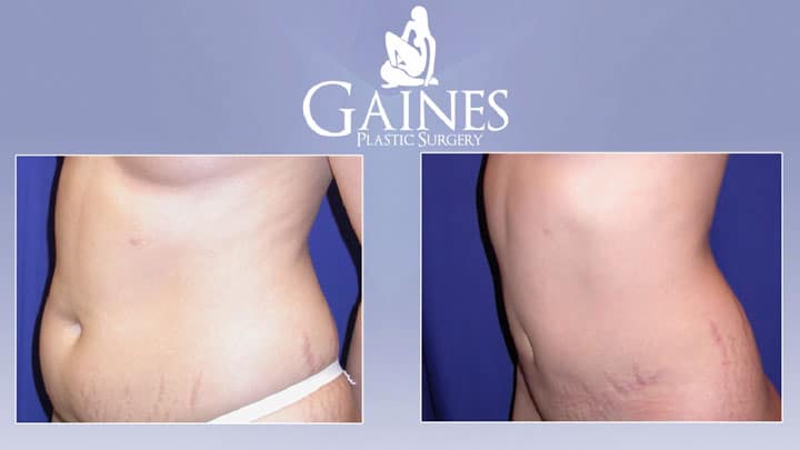 abdominoplasty th