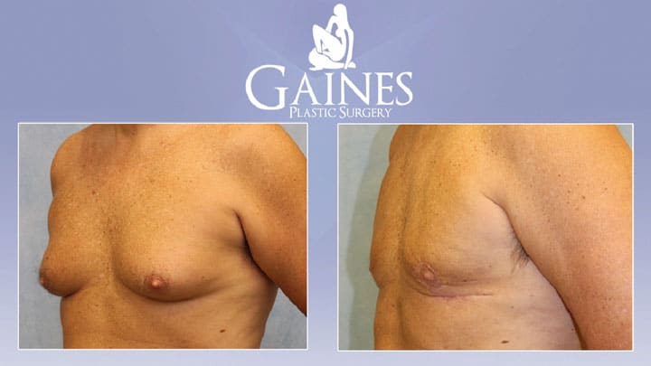 male breast reduction th