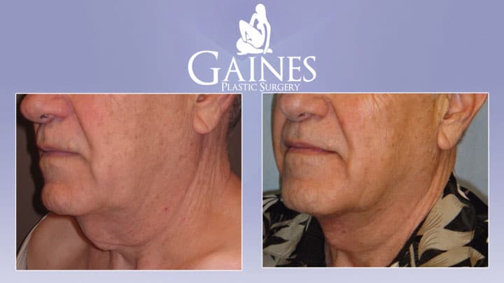 male direct neck lift th